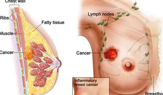 Người phụ nữ 62 tuổi ở Hà Nội phát hiện sớm ung thư vú từ việc làm quan trọng này