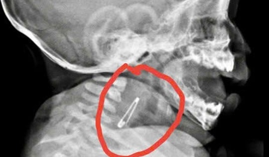 Bé 5 tháng tuổi vào viện cấp cứu khẩn vì nuốt kim băng đã bung mở