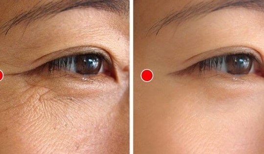 5 động tác đơn giản hằng ngày xóa mờ nếp nhăn đuôi mắt