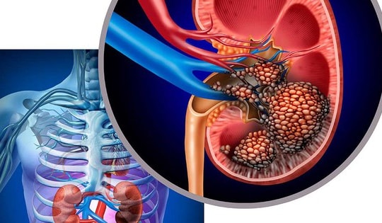 Người phụ nữ 46 tuổi ở TP HCM loại bỏ nguy cơ ung thư thận sớm từ 1 việc rất nhiều người Việt bỏ qua