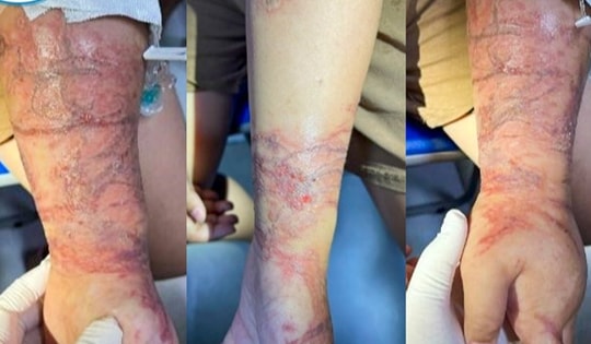 Bé gái phải cấp cứu vì tổn thương da chằng chịt do tiếp xúc với sứa khi tắm biển