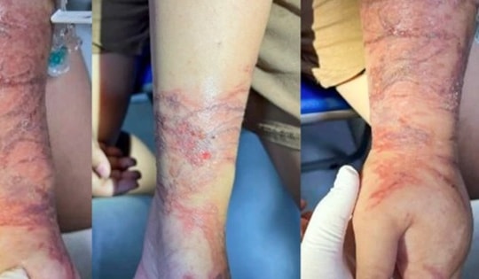 Tiếp xúc với sứa trong khi tắm biển, cánh tay bé gái tổn thương nặng nề