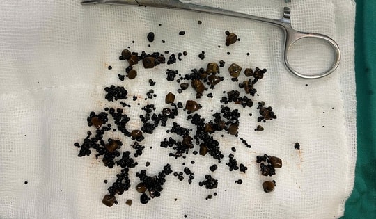 Người phụ nữ có túi mật 2 ngăn chứa hàng trăm viên sỏi