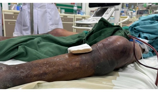 Người đàn ông ở Thanh Hóa nguy cơ hoại tử toàn thân, tiên lượng tử vong cao sau khi bị vật nhỏ này đâm vào chân