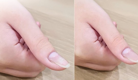 Đau ở ngón tay, bé 13 tuổi bất ngờ phát hiện bị u cuộn mạch, bác sĩ chỉ rõ có dấu hiệu này cần khám sớm