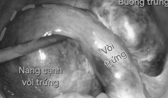 Bệnh viện tuyến quận cấp cứu thành công hai ca xoắn cơ quan sinh dục nguy hiểm