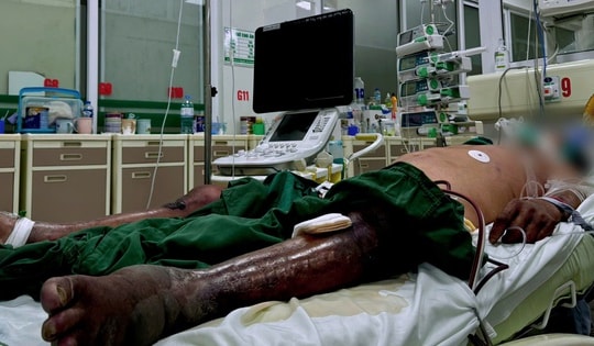 Chân hoại tử tím đen chỉ vì vết gai đâm khi lội đầm tôm