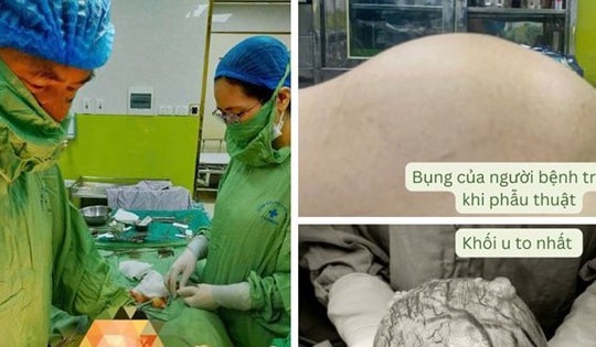 Người phụ nữ 42 tuổi ở Hòa Bình có khối u 'khủng' như mang thai 3 tháng từ sai lầm nhiều chị em Việt mắc phải