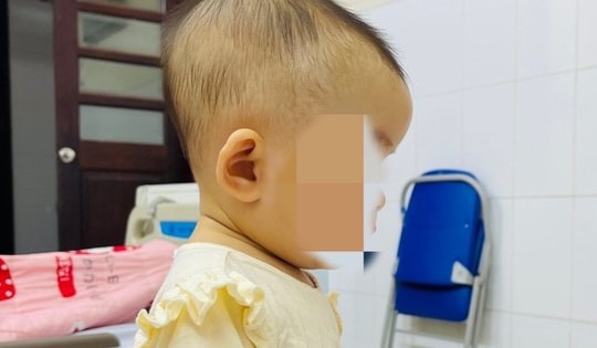 Bé 7 tháng tuổi tụ máu dưới da đầu từ cú ngã tưởng như vô hại