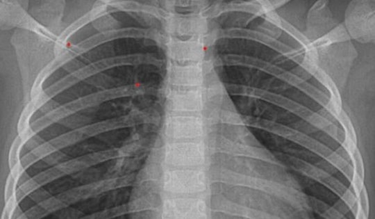Bé 3 tuổi ở Hà Nội đối diện với loạt biến chứng nguy hiểm do cúm B từ dấu hiệu nhiều trẻ em Việt mắc phải