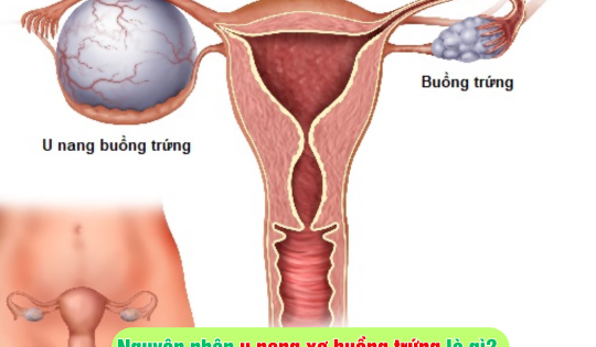 Nguyên nhân u nang xơ buồng trứng là gì?