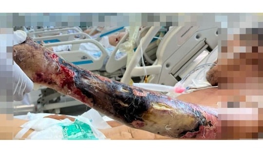 14 ngày căng thẳng giành giật sự sống cho bệnh nhân nhiễm vi khuẩn tụ cầu vàng