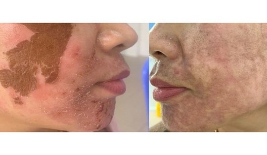 Trị nám 'cấp tốc': Trào lưu nguy hiểm từ các cơ sở thẩm mỹ 'chui'