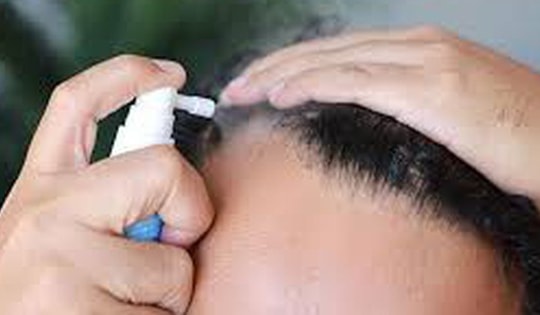 Thuốc điều trị rụng tóc tại chỗ có thể gây rối loạn cương dương, lo âu và sương mù não