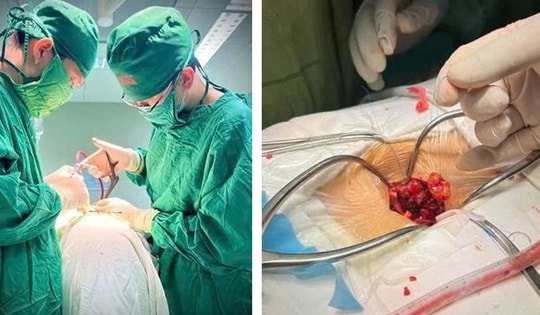 Bệnh viện Hữu nghị Đa khoa Nghệ An phẫu thuật thành công u tủy hình quả tạ