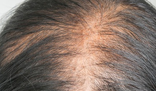 Các phương pháp điều trị rụng tóc tốt nhất cho phụ nữ