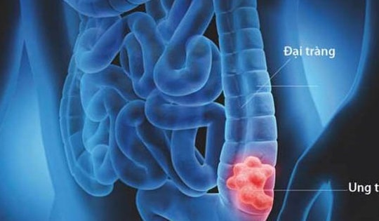 5 bí quyết giảm nguy cơ mắc ung thư đại tràng