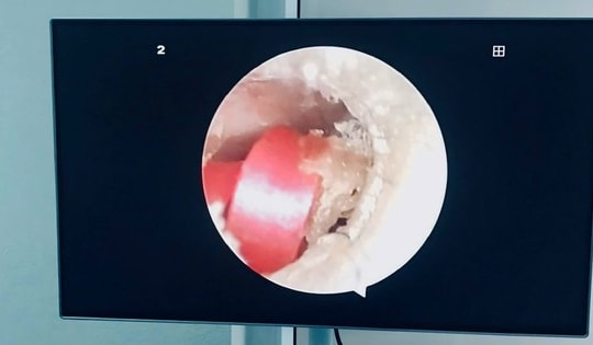 Bé gái 6 tuổi đi viện do sợi dây chun buộc tóc