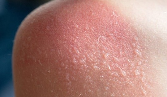 Cách khắc phục làn da bị cháy nắng