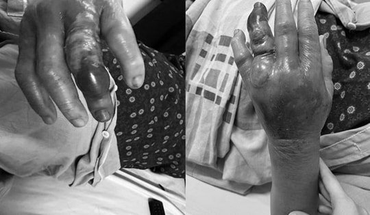 Người phụ nữ 63 tuổi nhập viện khẩn sau khi bị gai loài cá này đâm vào tay