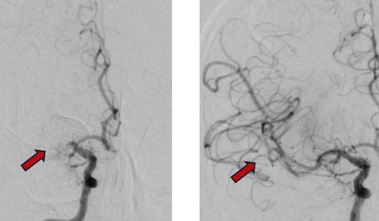 Bệnh viện Nhân Dân 115 cứu sống bệnh nhân người Nga bị đột quỵ
