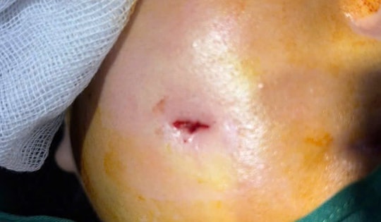 Người phụ nữ bị biến chứng sau phẫu thuật thẩm mỹ tạo má lúm đồng tiền