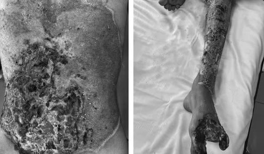 Cảnh báo: Tổn thương nặng do tự đắp thuốc chữa bỏng tại nhà