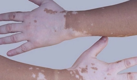 Tổn thương mất màu trên da cảnh báo bệnh bạch biến