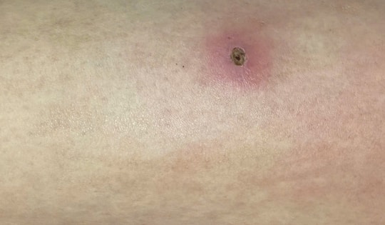 Ăn món khoái khẩu, hai anh em bàng hoàng khi sán chui ra từ chân