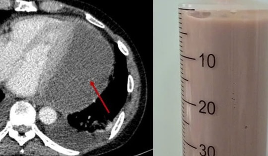 Người đàn ông nghiện rượu có mủ đặc quánh bao quanh tim hiếm gặp