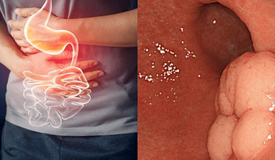 2 vợ chồng trẻ cùng mắc ung thư dạ dày thừa nhận một sai lầm nhiều bạn trẻ Việt mắc phải