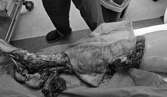 Người phụ nữ bị lóc da toàn bộ chân do xe tải cán qua