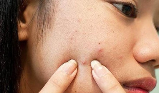 Sau nặn mụn không nên ăn gì?