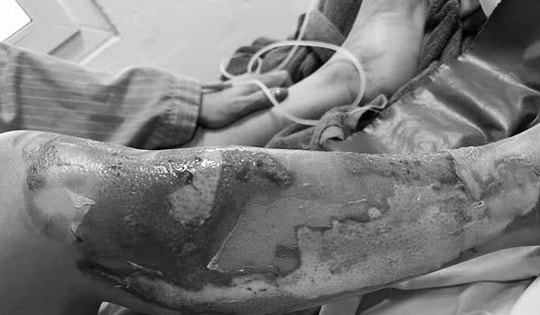 Nướng cá bằng cồn người phụ nữ bị bỏng nặng