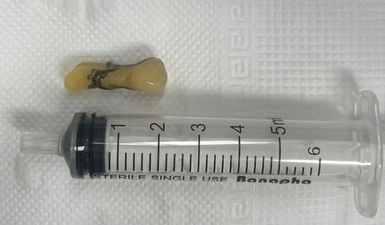 Gắp chiếc răng của cụ ông bị đột quỵ não rơi vào đường thở