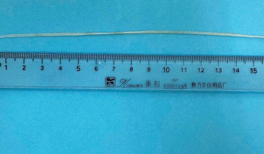 Tưởng chỉ là sưng tấy, bất ngờ bác sĩ rút được giun rồng dài gần 20 cm từ vết thương