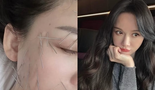 Tranh cãi chuyện nữ diễn viên nổi tiếng găm cả trăm cây kim lên mặt để 'trẻ mãi không già'
