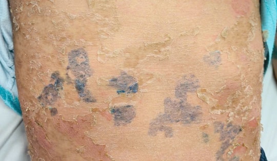 Nam thanh niên 17 tuổi nhập viện do điều trị sởi sai cách, bác sĩ chỉ rõ sai lầm gây biến chứng nguy hiểm