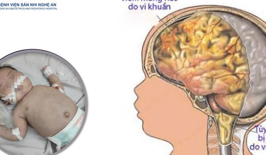 Cứu bé 20 ngày tuổi nguy kịch do viêm não mô cầu