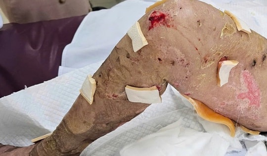 Người phụ nữ mắc hội chứng Lyell, bị hoại tử thượng bì 92%