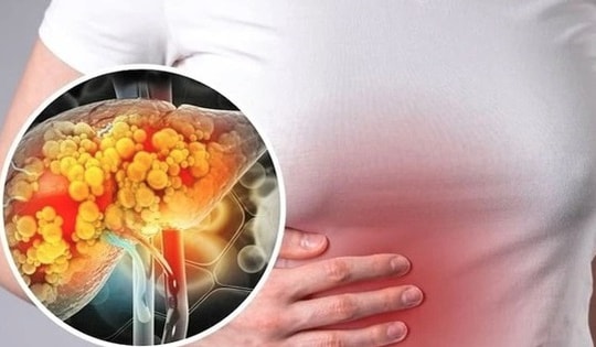 6 cách ngăn ngừa và kiểm soát bệnh gan nhiễm mỡ an toàn và hiệu quả