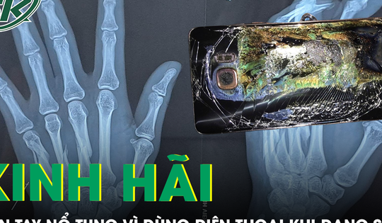 Kinh hãi hình ảnh bàn tay bị nổ tung vì dùng điện thoại trong lúc sạc