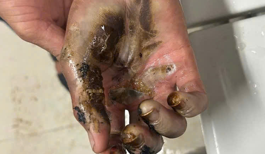 Nam sinh bỏng nặng khi thả diều gần đường điện cao thế