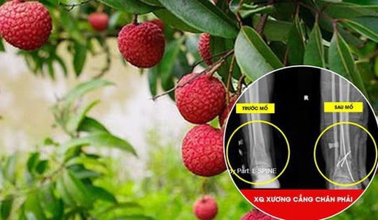 Người đàn ông 51 tuổi ở Phú Thọ nhập viện gấp sau khi trèo cây hái vải