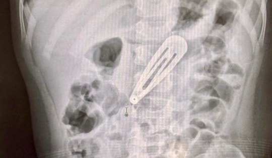 Bé gái 21 tháng tuổi nhập viện gấp với chiếc kẹp tóc trong dạ dày