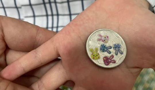 Bé gái nguy kịch vì nuốt phải đồng xu