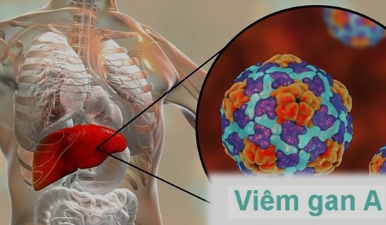 Lưu ý 6 nhóm thực phẩm gây hại gan, không nên ăn để phòng bệnh viêm gan A
