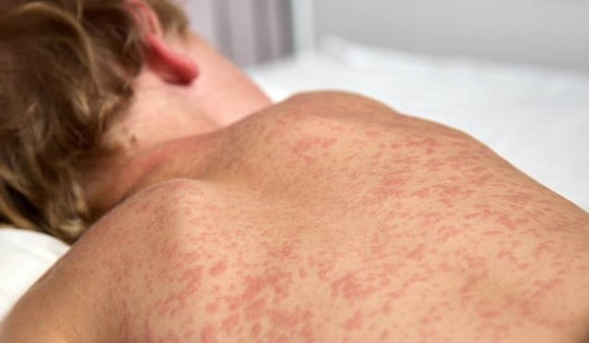 Cảnh giác với dấu hiệu bệnh sởi ở trẻ