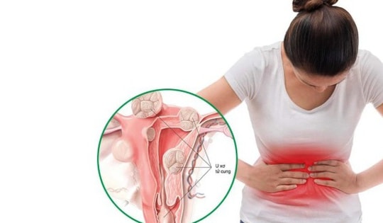 Người phụ nữ 39 tuổi phát hiện khối u hiếm gặp trong tử cung từ dấu hiệu nhiều chị em Việt mắc phải