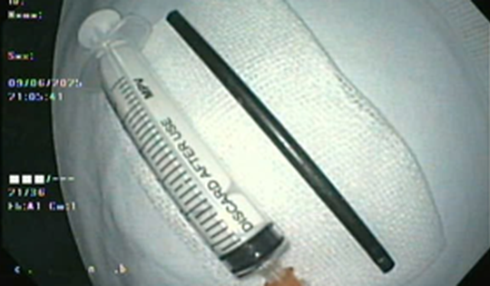 Bệnh nhi đau bụng ba ngày, vào viện mới biết có dị vật đường tiêu hóa